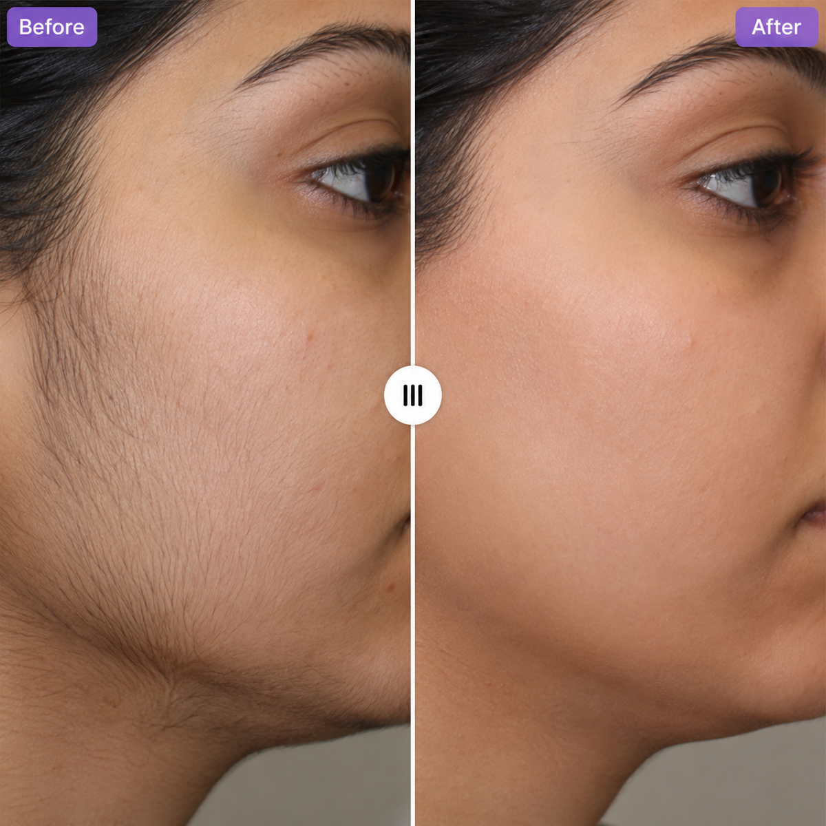 Vynrel Hair Removal Trilogy Kit before and after, jaw